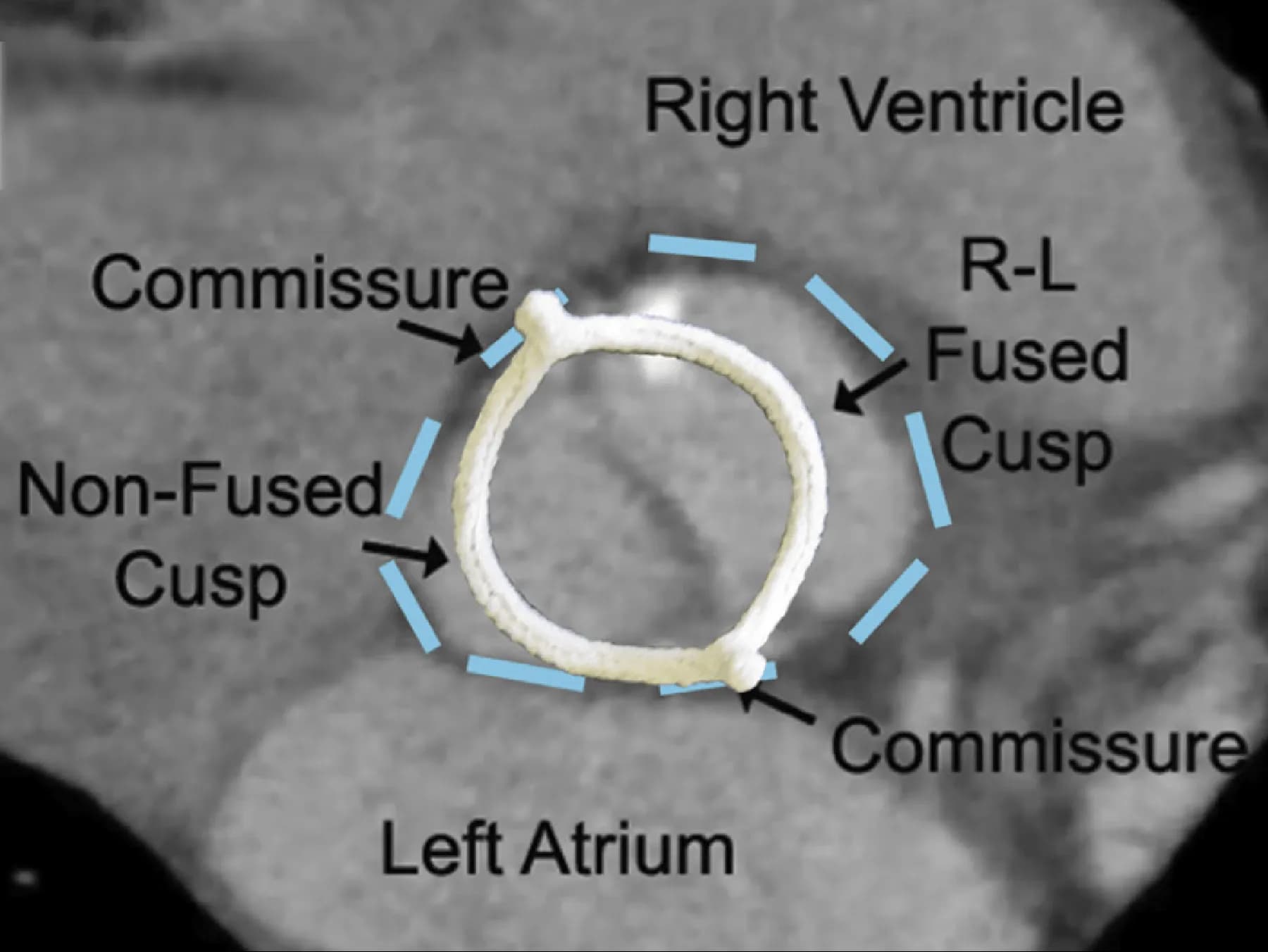 CT scan showing HAART 200 device implanted in the aortic annulus, viewed from above, with labeled commissures, non-fused cusp, and right-left fused cusp positioned symmetrically at 180 degrees