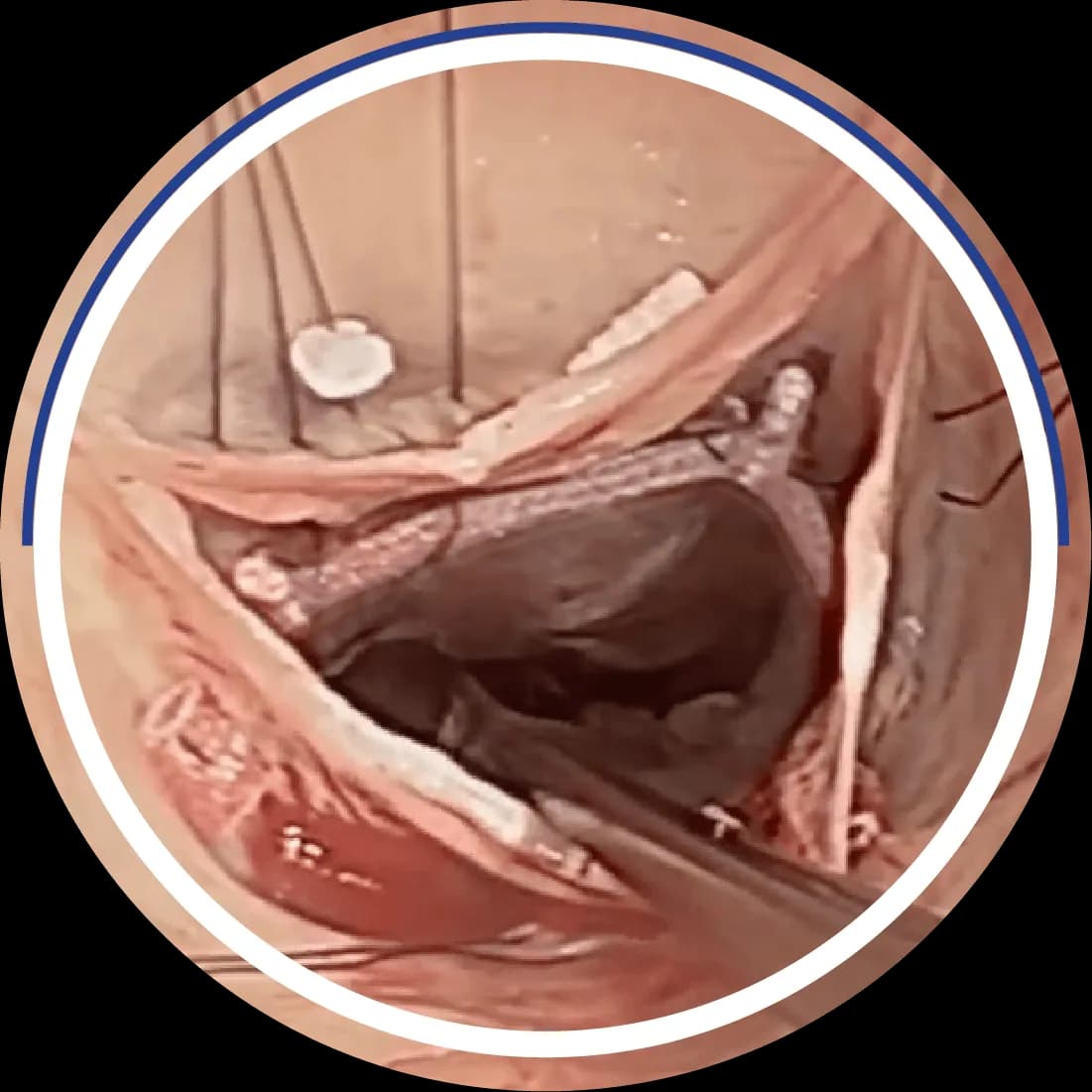 Intraoperative photo showing HAART 200 device being placed internally sub-valvularly inside the aortic root, with retraction sutures holding the aortotomy open