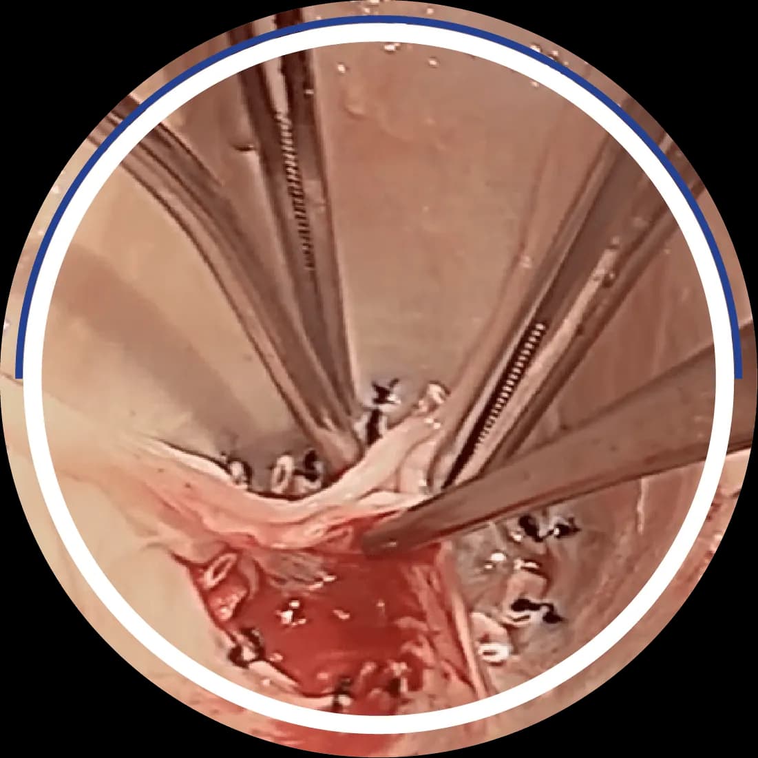 Intraoperative photo showing aortic valve leaflet reconstruction with HAART 200 device sutures in place, retraction sutures holding leaflets apart for simplified repair