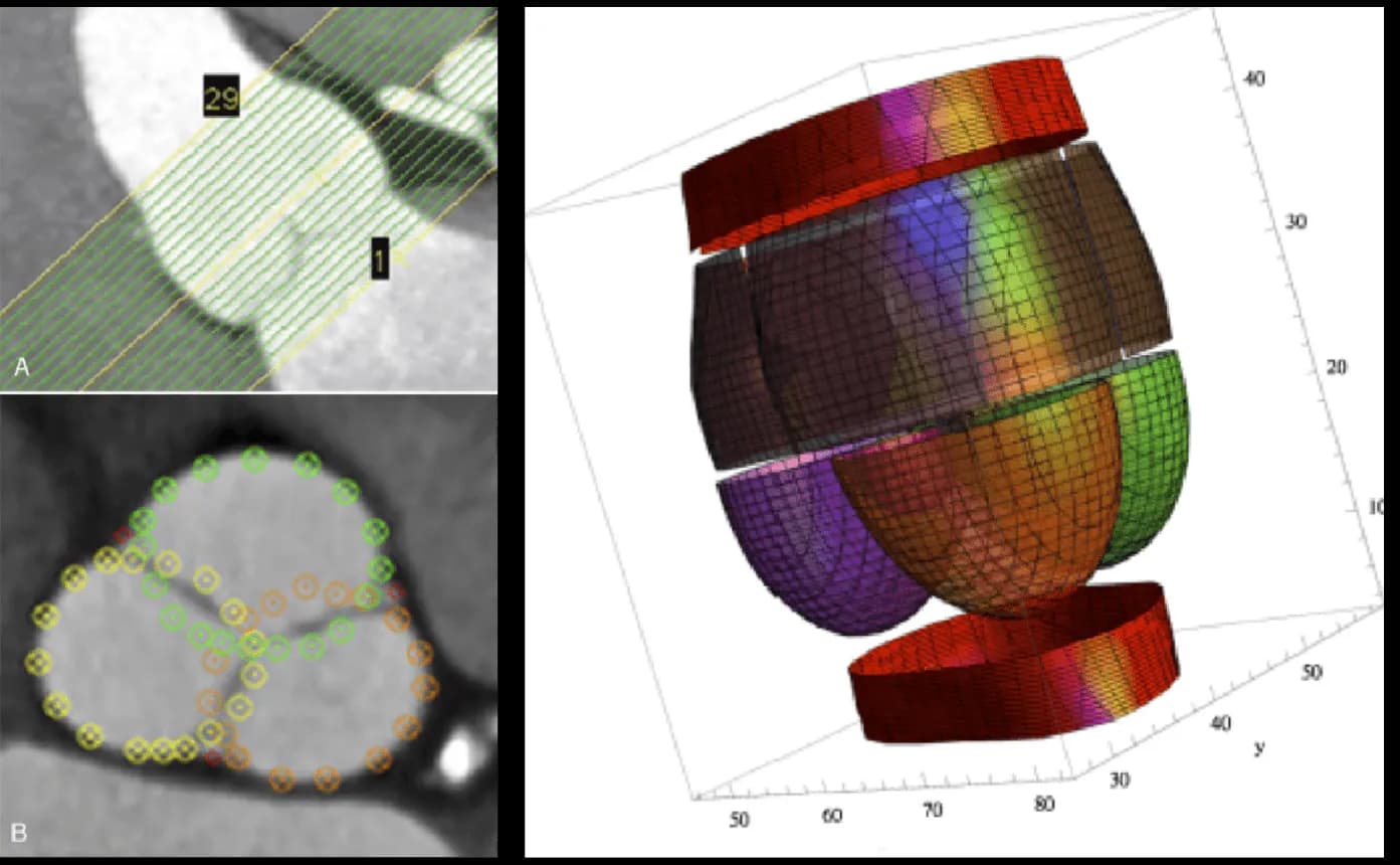 Figure showing HAART 300 design basis: CT scans and 3D reconstructed aortic root model with three-leaflet segmentation