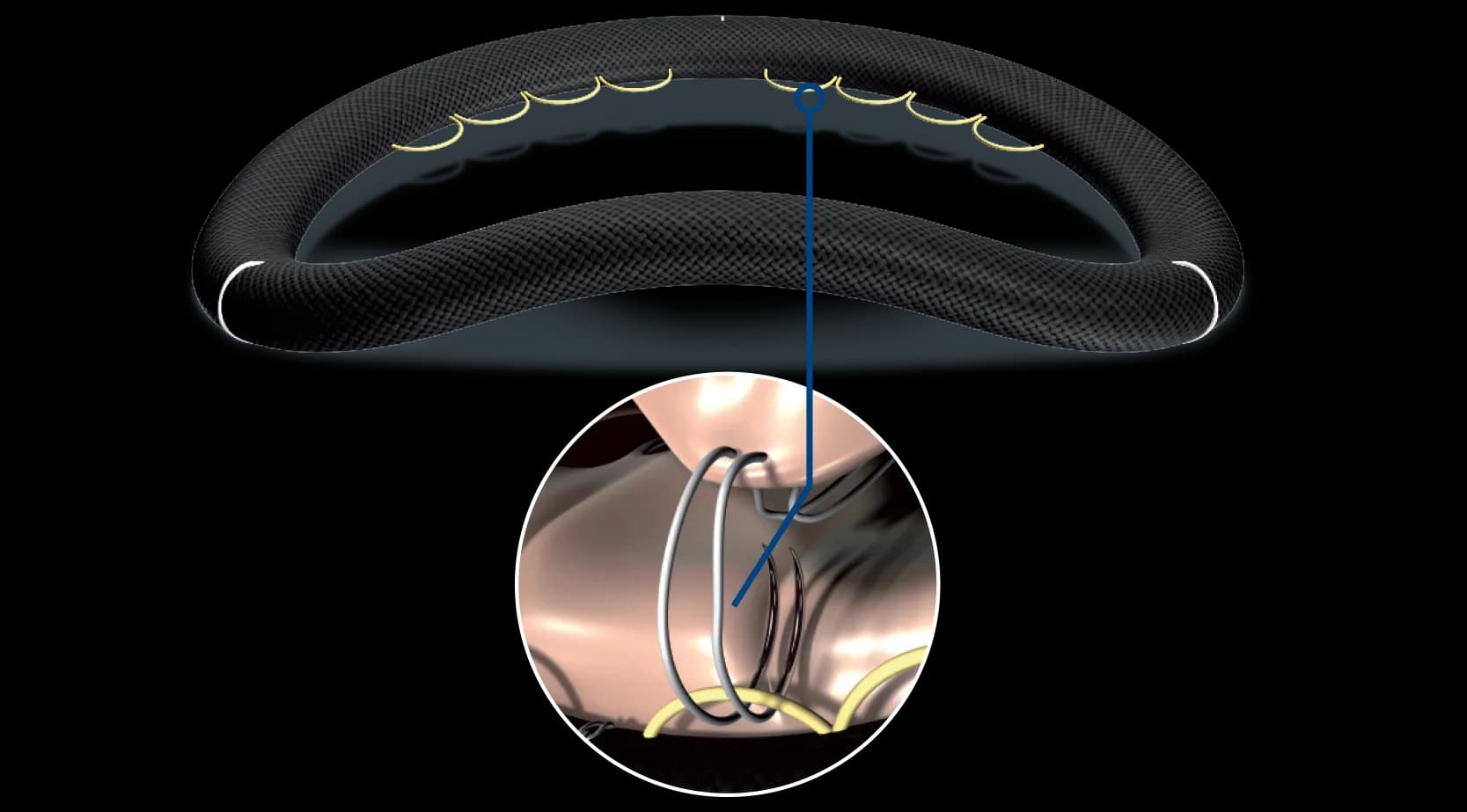 Memo 4D mitral ring with guide loops illustrating the ReChord system for standardized chordal sizing and knotting