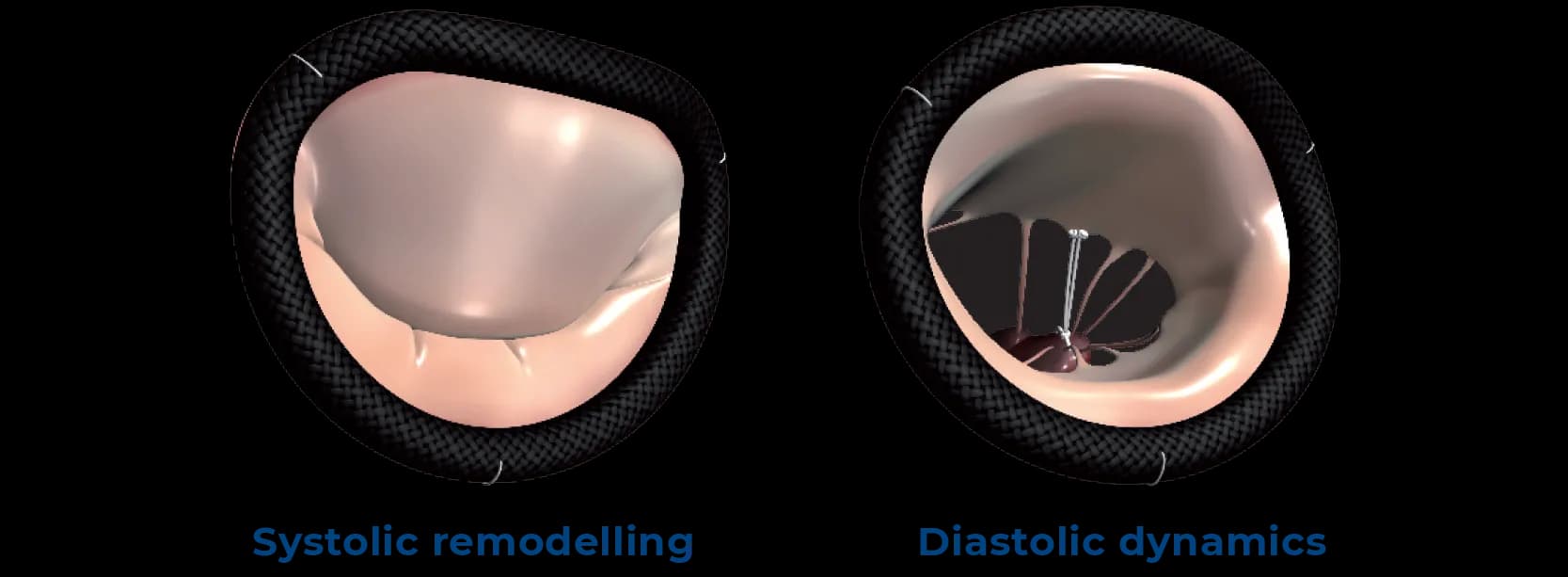 Two illustrations of a mitral valve with a Memo 4D ring: left shows systolic remodeling with closed leaflets, right shows diastolic dynamics with open leaflets
