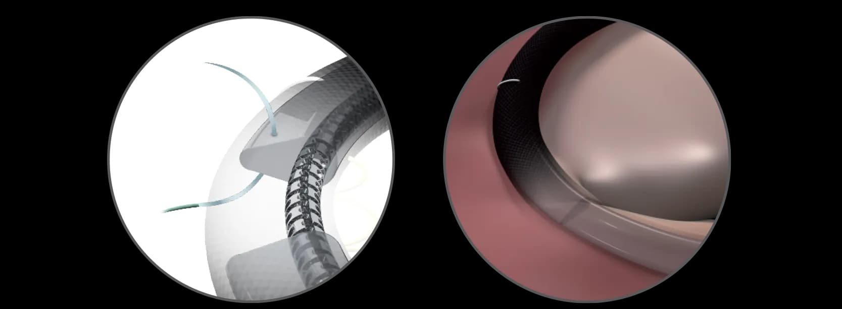 Memo 4D mitral valve repair slim fit, optimally fit to the patient annulus