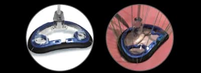 Memo 4D mitral ring on delivery holder showing a chordal window for neochordae passage and one-cut removal design for easy unhooking