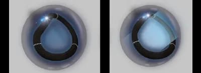 Side-by-side image of a Memo 4D mitral ring at rest and with dynamic deformation